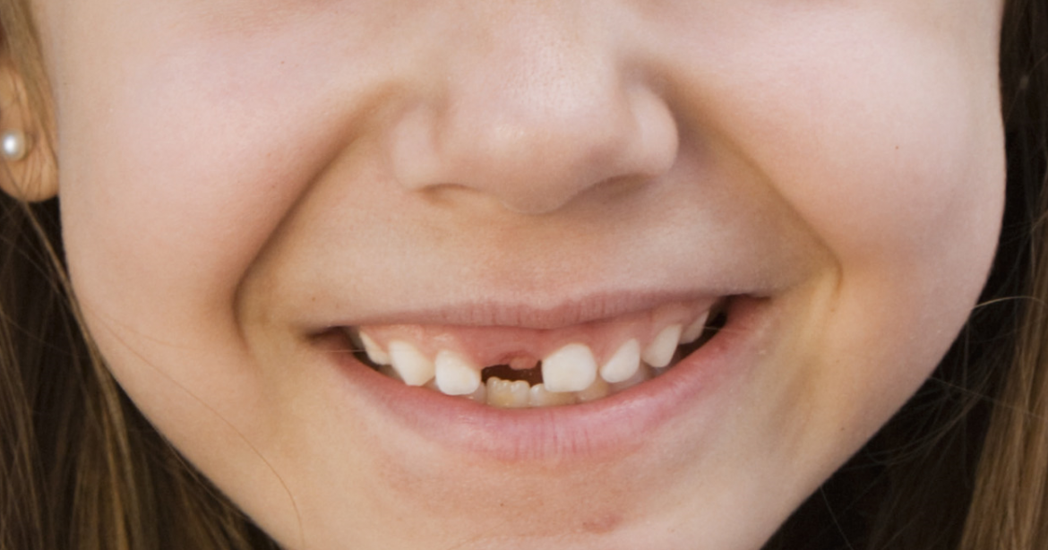 Lost-first-tooth-milestone-Emma